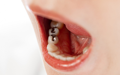 歯周病で溶けた骨は再生できるの？