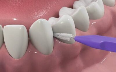歯周病が手遅れになる症状とは？