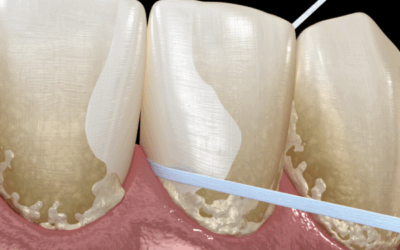 歯石を除去する方法って？