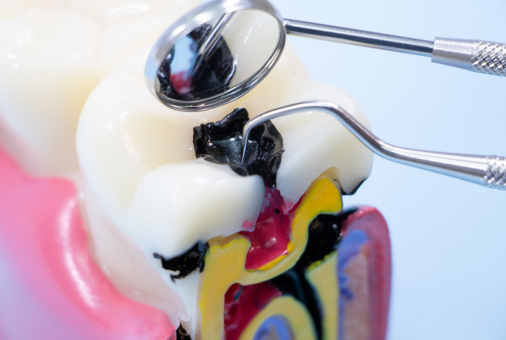 根面被覆術（歯肉移植術）