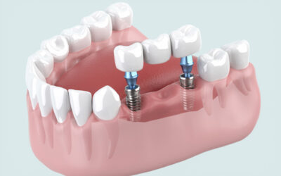 インプラント治療はどのような場合に適しているの？