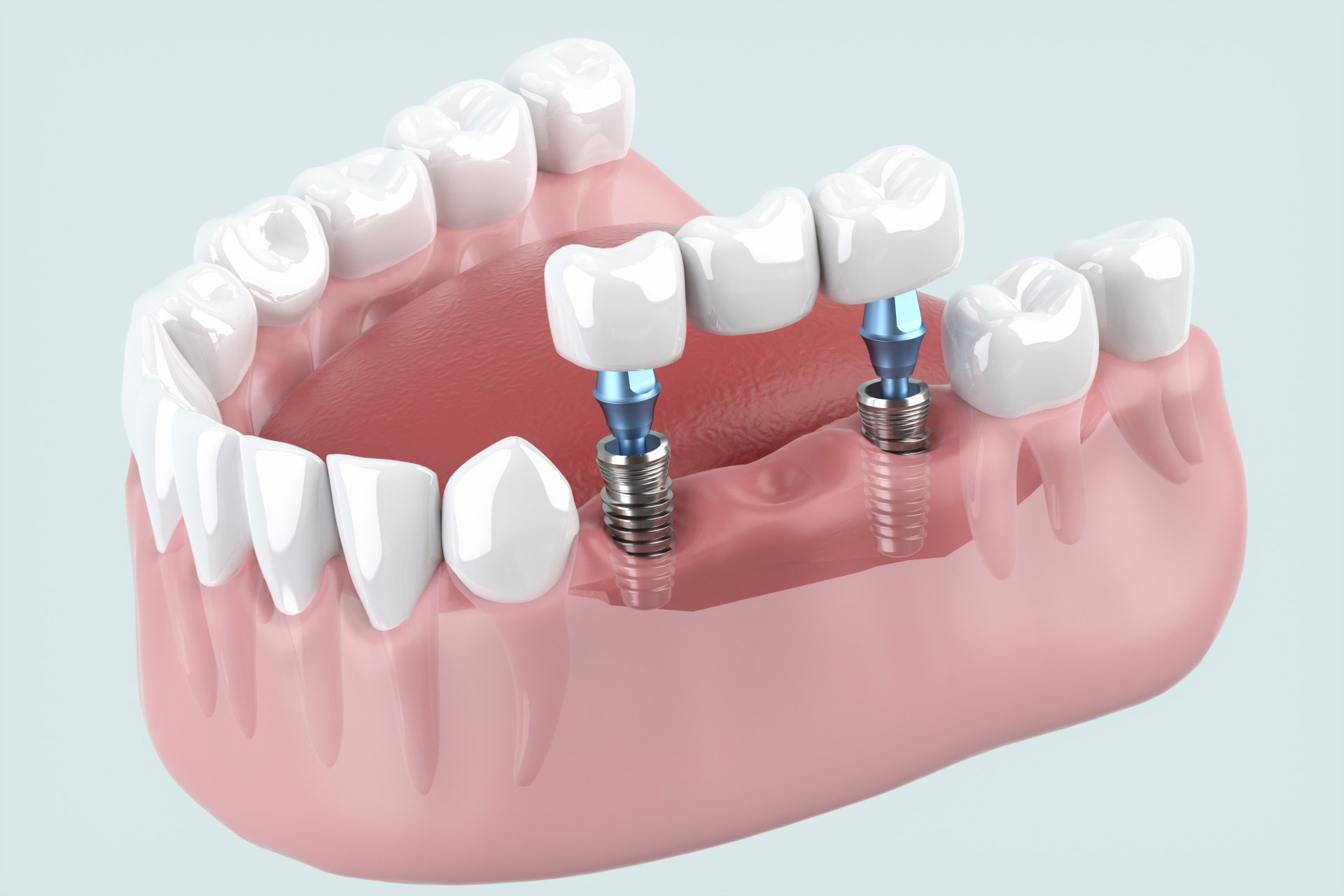 矯正治療の無料相談