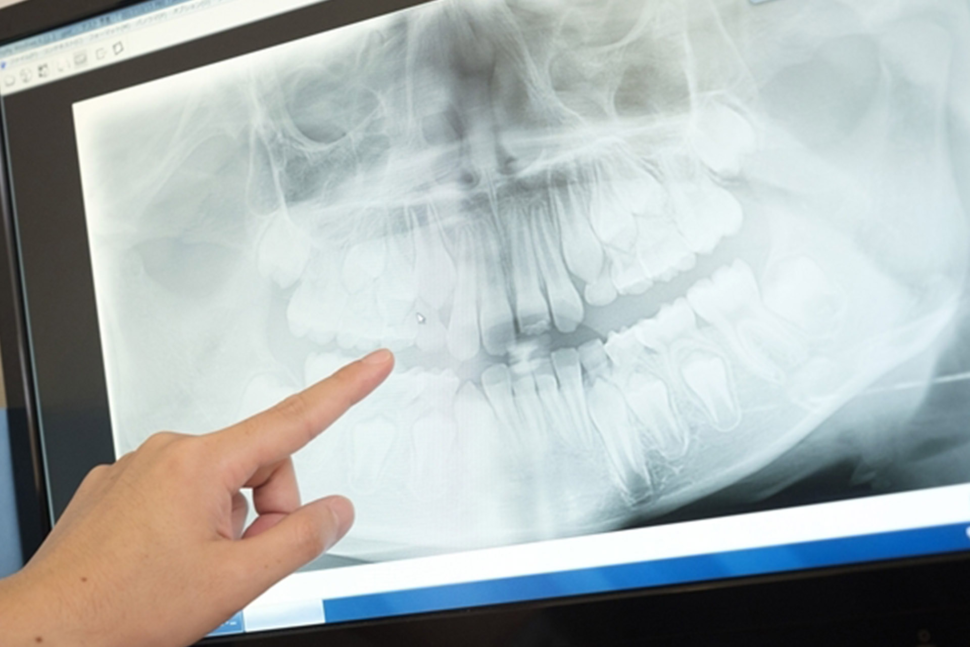 矯正治療の無料相談