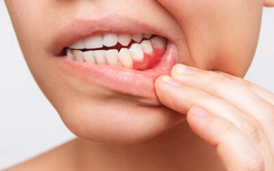 歯ぐきの役割と口腔健康への影響