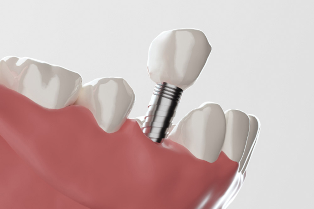 インプラント治療